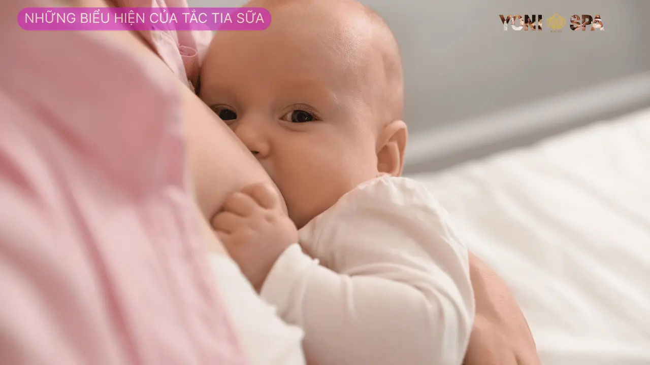 Những biểu hiện của tắc tia sữa